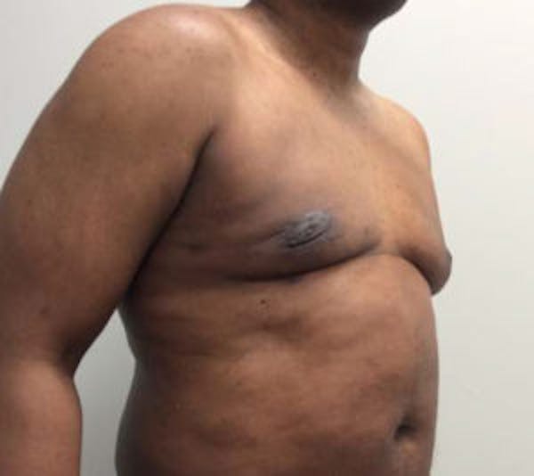 Gynecomastia Before & After Gallery - Patient 4595112 - Image 4