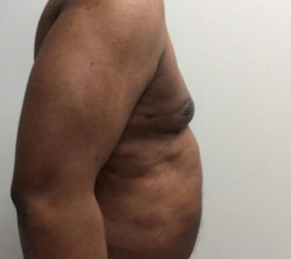 Gynecomastia Before & After Gallery - Patient 4595112 - Image 6