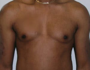 Gynecomastia