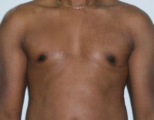 Gynecomastia