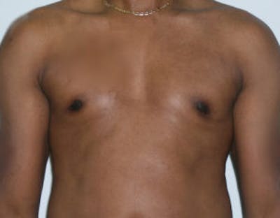 Gynecomastia Before & After Gallery - Patient 4595113 - Image 2