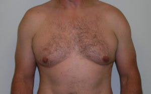 Gynecomastia