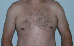 Gynecomastia