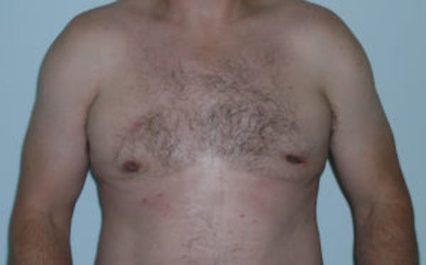 Gynecomastia Before & After Gallery - Patient 4595115 - Image 2
