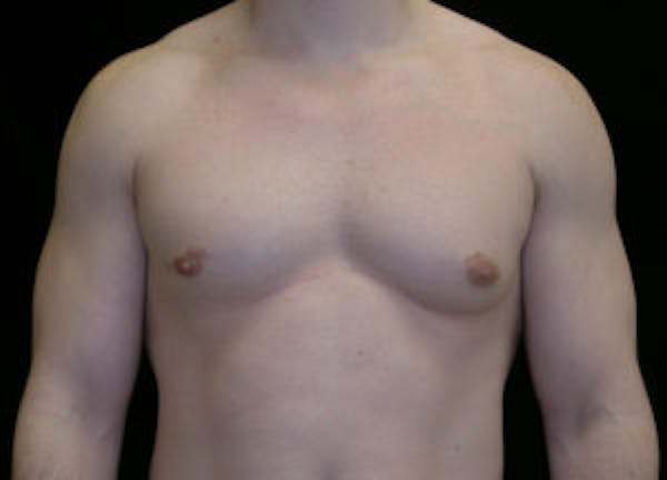 Gynecomastia Before & After Gallery - Patient 4595116 - Image 1