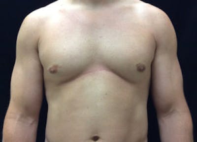 Gynecomastia Before & After Gallery - Patient 4595116 - Image 2