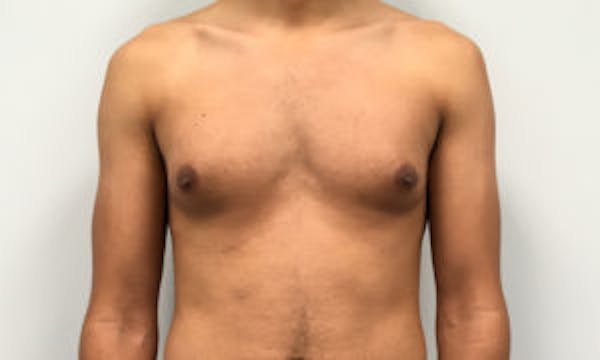 Gynecomastia Before & After Gallery - Patient 4595117 - Image 1