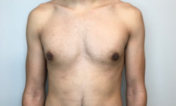 Gynecomastia Before & After Gallery - Patient 4595117 - Image 2