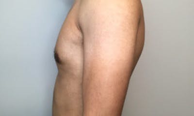Gynecomastia Before & After Gallery - Patient 4595117 - Image 4