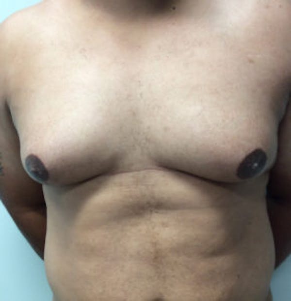 Gynecomastia Before & After Gallery - Patient 4595118 - Image 1