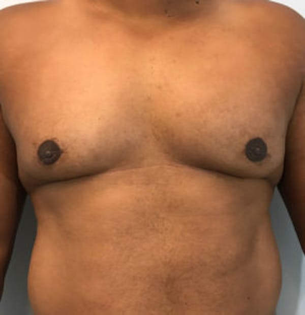 Gynecomastia Before & After Gallery - Patient 4595118 - Image 2