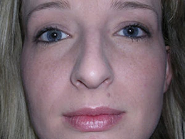Rhinoplasty Before & After Gallery - Patient 4595119 - Image 1