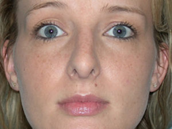 Rhinoplasty Before & After Gallery - Patient 4595119 - Image 2