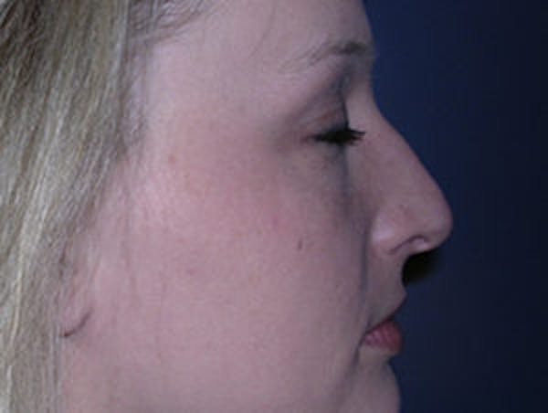 Rhinoplasty Before & After Gallery - Patient 4595119 - Image 3