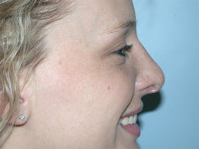 Rhinoplasty Before & After Gallery - Patient 4595119 - Image 4