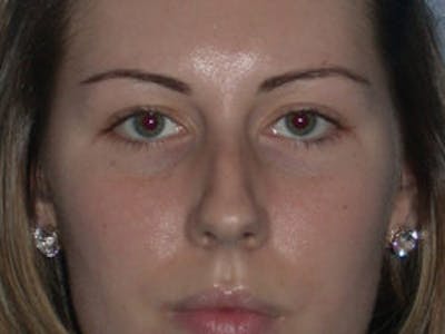 Rhinoplasty Before & After Gallery - Patient 4595120 - Image 1