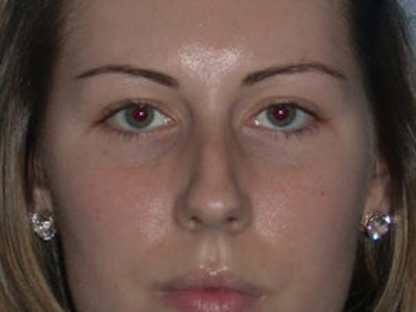 Rhinoplasty Before & After Gallery - Patient 4595120 - Image 1