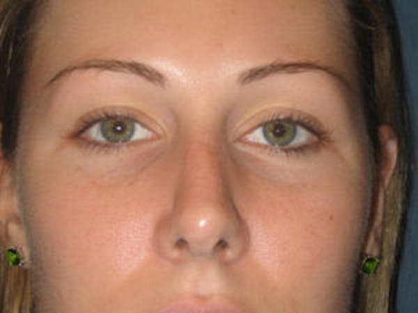 Rhinoplasty Before & After Gallery - Patient 4595120 - Image 2