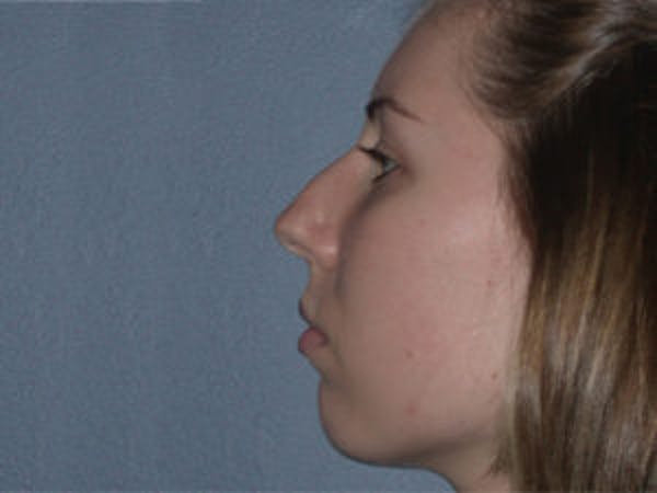 Rhinoplasty Before & After Gallery - Patient 4595120 - Image 3