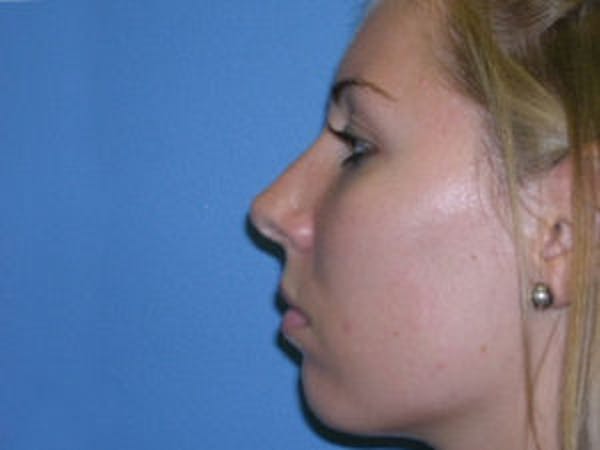 Rhinoplasty Before & After Gallery - Patient 4595120 - Image 4