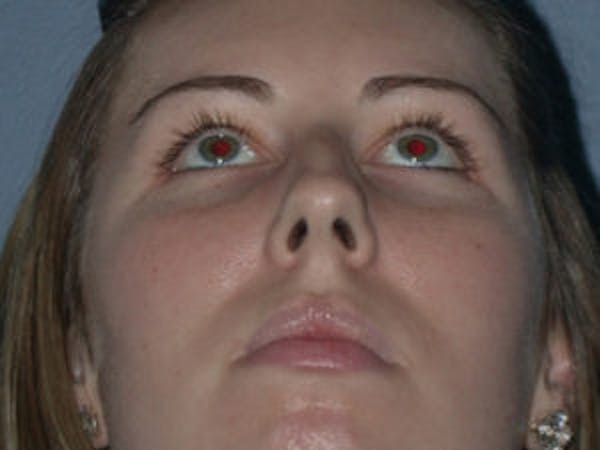 Rhinoplasty Before & After Gallery - Patient 4595120 - Image 5