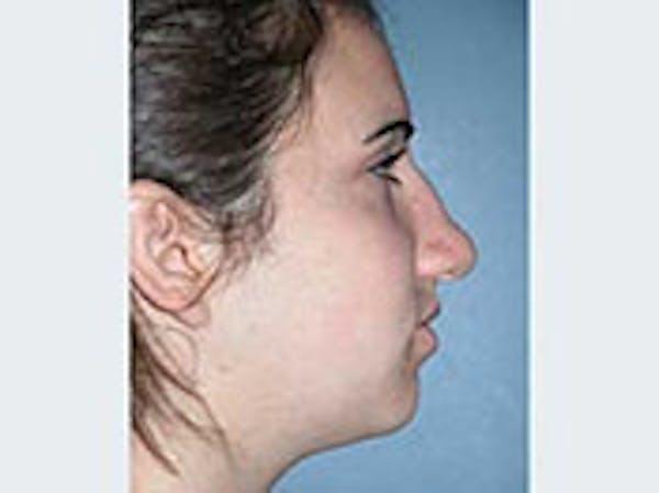 Rhinoplasty Before & After Gallery - Patient 4595124 - Image 1