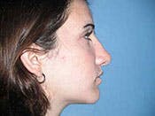 Rhinoplasty