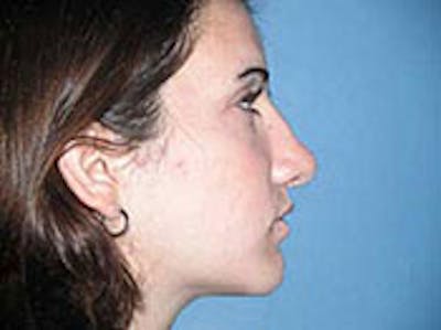 Rhinoplasty Before & After Gallery - Patient 4595124 - Image 2