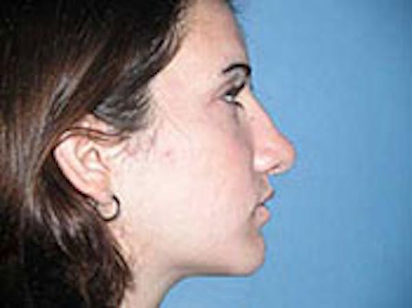 Rhinoplasty Before & After Gallery - Patient 4595124 - Image 2