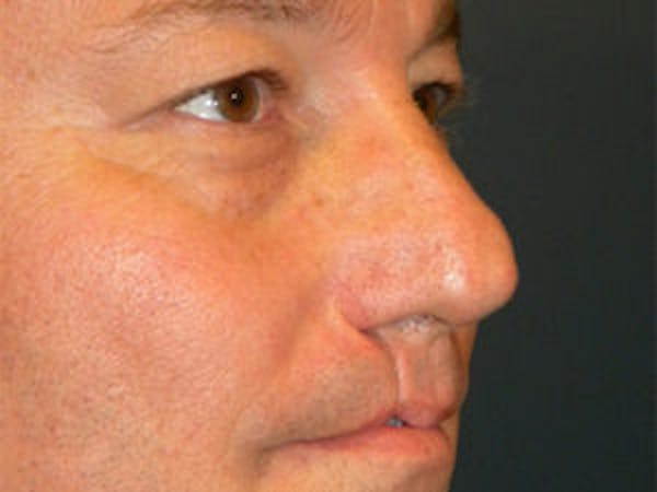 Rhinoplasty Before & After Gallery - Patient 4595126 - Image 3