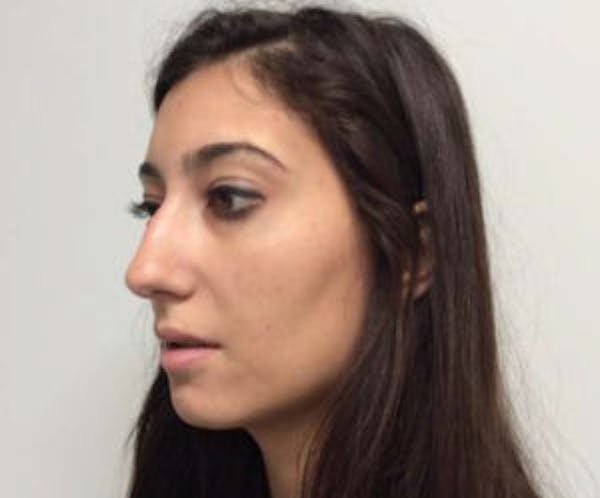 Rhinoplasty Before & After Gallery - Patient 4595130 - Image 3