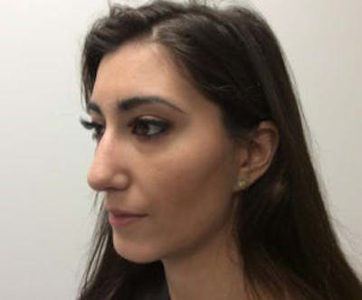 Rhinoplasty Before & After Gallery - Patient 4595130 - Image 4