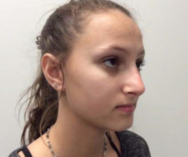 Rhinoplasty Before & After Gallery - Patient 4595131 - Image 2