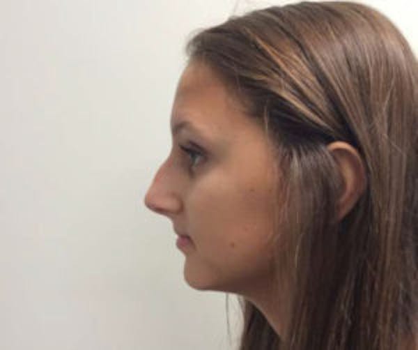 Rhinoplasty Before & After Gallery - Patient 4595131 - Image 3