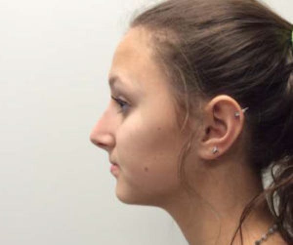 Rhinoplasty Before & After Gallery - Patient 4595131 - Image 4
