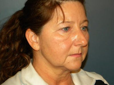 Neck Lift Before & After Gallery - Patient 4595140 - Image 1
