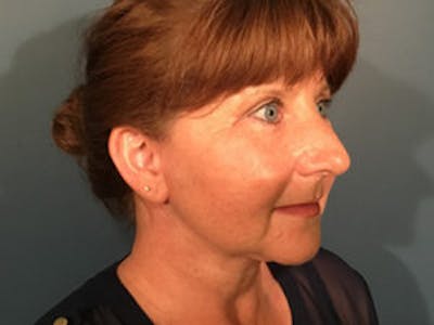 Neck Lift Before & After Gallery - Patient 4595140 - Image 2