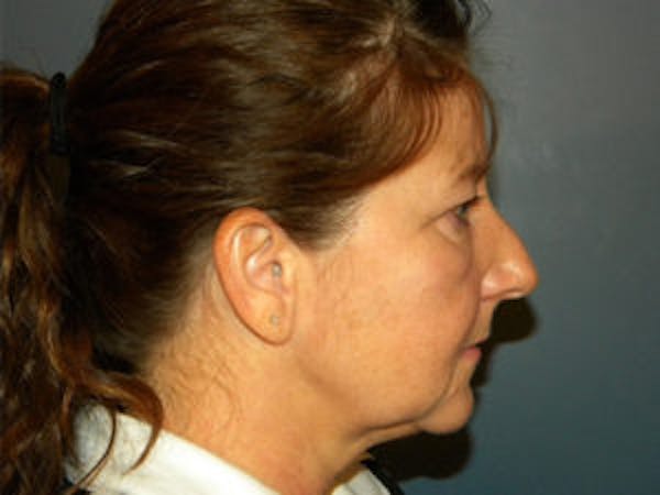 Neck Lift Before & After Gallery - Patient 4595140 - Image 3