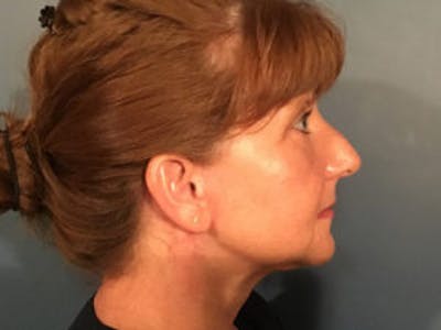 Neck Lift Before & After Gallery - Patient 4595140 - Image 4