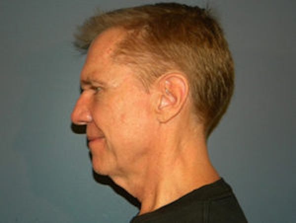 Neck Lift Before & After Gallery - Patient 4595144 - Image 3