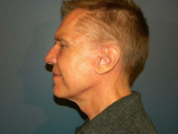 Neck Lift Before & After Gallery - Patient 4595144 - Image 4