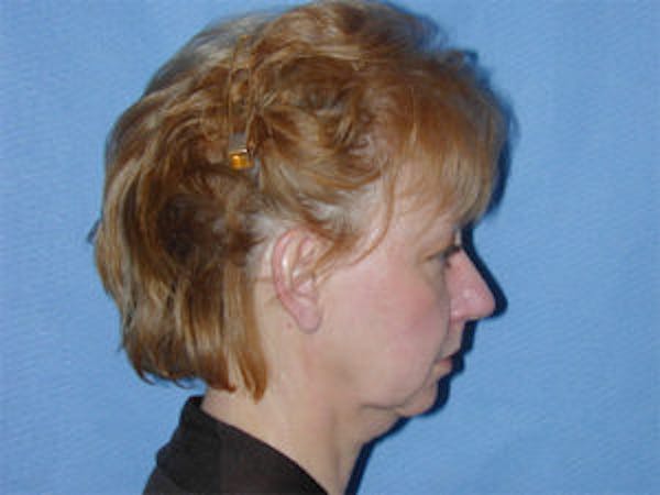 Neck Lift Before & After Gallery - Patient 4595148 - Image 3