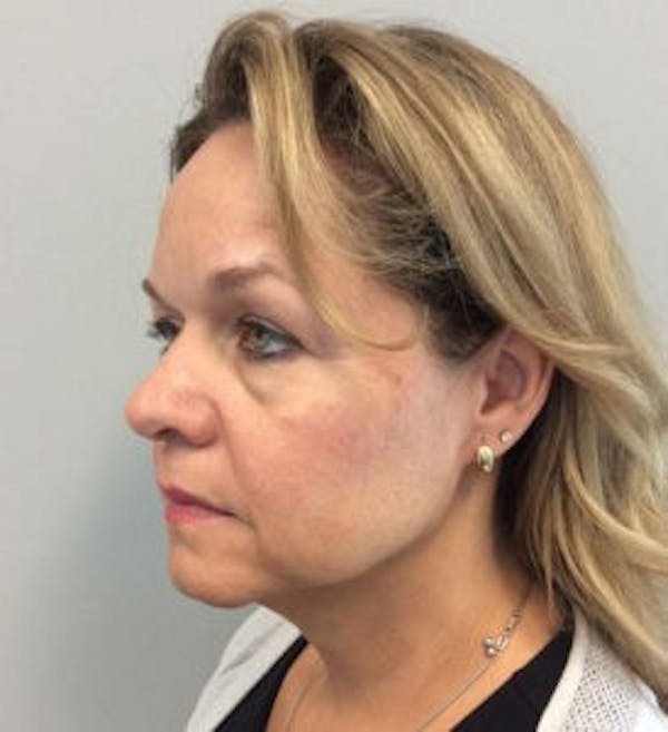 Neck Lift Before & After Gallery - Patient 4595150 - Image 3
