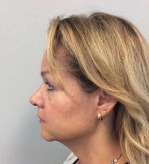 Neck Lift Before & After Gallery - Patient 4595150 - Image 5