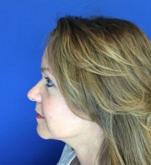Neck Lift Before & After Gallery - Patient 4595150 - Image 6