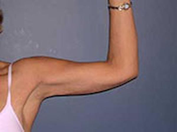 Arm Lift Before & After Gallery - Patient 4595154 - Image 2
