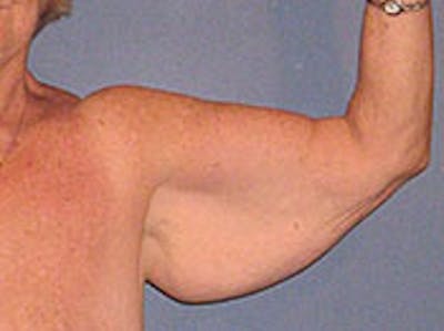 Arm Lift Before & After Gallery - Patient 4595155 - Image 1