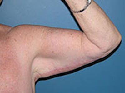 Arm Lift Before & After Gallery - Patient 4595155 - Image 2