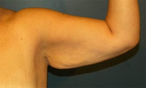 Arm Lift Before & After Gallery - Patient 4595156 - Image 1