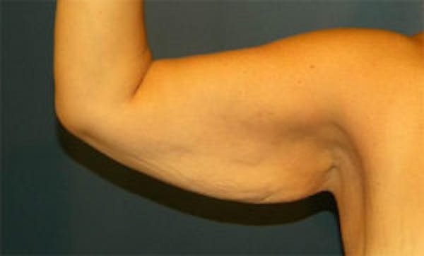 Arm Lift Before & After Gallery - Patient 4595156 - Image 3
